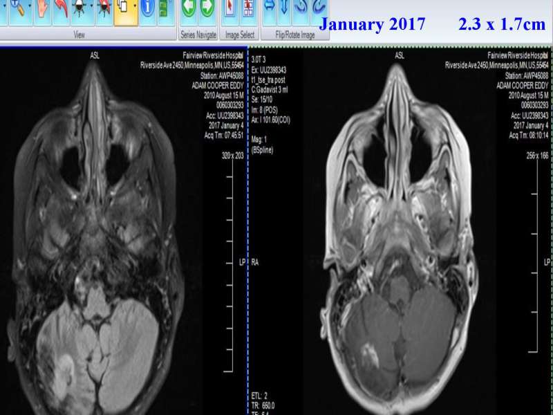 Emotional roots in Brain Cancers page 37